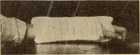 An illustration from Fractures and dislocations, diagnosis and treatment (1915)