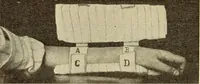 Picture 176 of 481 from Fractures and dislocations, diagnosis and treatment (1915), leaf 255