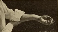An illustration from Fractures and dislocations, diagnosis and treatment (1915)