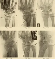 Picture 181 of 481 from Fractures and dislocations, diagnosis and treatment (1915), leaf 274