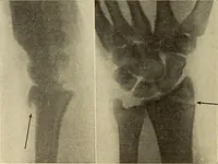 Picture 183 of 481 from Fractures and dislocations, diagnosis and treatment (1915), leaf 275