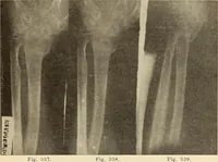 An illustration from Fractures and dislocations, diagnosis and treatment (1915)