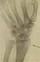 An illustration from Fractures and dislocations, diagnosis and treatment (1915)