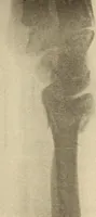 Picture 186 of 481 from Fractures and dislocations, diagnosis and treatment (1915), leaf 278