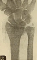 Picture 187 of 481 from Fractures and dislocations, diagnosis and treatment (1915), leaf 278