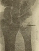 An illustration from Fractures and dislocations, diagnosis and treatment (1915)