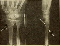 Picture 189 of 481 from Fractures and dislocations, diagnosis and treatment (1915), leaf 279