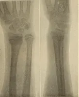 Picture 190 of 481 from Fractures and dislocations, diagnosis and treatment (1915), leaf 280