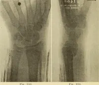 Picture 191 of 481 from Fractures and dislocations, diagnosis and treatment (1915), leaf 281