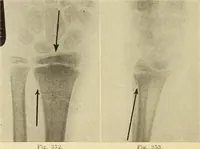 Picture 192 of 481 from Fractures and dislocations, diagnosis and treatment (1915), leaf 281