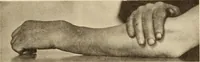 Picture 193 of 481 from Fractures and dislocations, diagnosis and treatment (1915), leaf 286