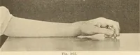 An illustration from Fractures and dislocations, diagnosis and treatment (1915)