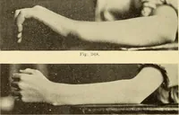 Picture 195 of 481 from Fractures and dislocations, diagnosis and treatment (1915), leaf 289