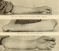 Picture 196 of 481 from Fractures and dislocations, diagnosis and treatment (1915), leaf 292