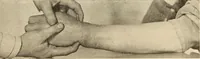 An illustration from Fractures and dislocations, diagnosis and treatment (1915)