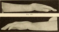 An illustration from Fractures and dislocations, diagnosis and treatment (1915)