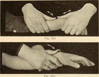 An illustration from Fractures and dislocations, diagnosis and treatment (1915)