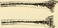 An illustration from Fractures and dislocations, diagnosis and treatment (1915)