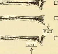Picture 201 of 481 from Fractures and dislocations, diagnosis and treatment (1915), leaf 295