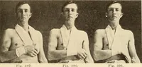 Picture 203 of 481 from Fractures and dislocations, diagnosis and treatment (1915), leaf 298