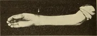 An illustration from Fractures and dislocations, diagnosis and treatment (1915)