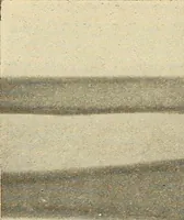 An illustration from Fractures and dislocations, diagnosis and treatment (1915)