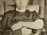 Picture 206 of 481 from Fractures and dislocations, diagnosis and treatment (1915), leaf 306