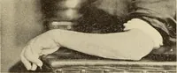 An illustration from Fractures and dislocations, diagnosis and treatment (1915)