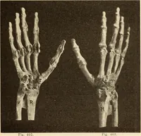 An illustration from Fractures and dislocations, diagnosis and treatment (1915)