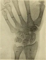 An illustration from Fractures and dislocations, diagnosis and treatment (1915)