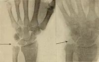 Picture 210 of 481 from Fractures and dislocations, diagnosis and treatment (1915), leaf 310