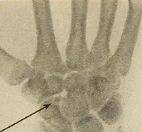 An illustration from Fractures and dislocations, diagnosis and treatment (1915)