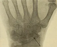 Picture 212 of 481 from Fractures and dislocations, diagnosis and treatment (1915), leaf 311