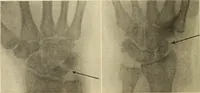 Picture 213 of 481 from Fractures and dislocations, diagnosis and treatment (1915), leaf 311