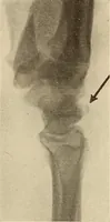 Picture 214 of 481 from Fractures and dislocations, diagnosis and treatment (1915), leaf 312