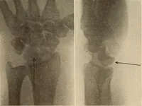 Picture 215 of 481 from Fractures and dislocations, diagnosis and treatment (1915), leaf 312