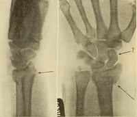 An illustration from Fractures and dislocations, diagnosis and treatment (1915)
