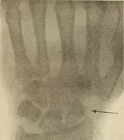 An illustration from Fractures and dislocations, diagnosis and treatment (1915)