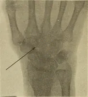 An illustration from Fractures and dislocations, diagnosis and treatment (1915)