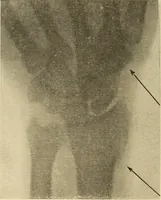 An illustration from Fractures and dislocations, diagnosis and treatment (1915)