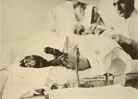 Picture 220 of 481 from Fractures and dislocations, diagnosis and treatment (1915), leaf 318