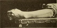 Picture 221 of 481 from Fractures and dislocations, diagnosis and treatment (1915), leaf 319