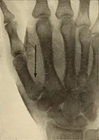 Picture 222 of 481 from Fractures and dislocations, diagnosis and treatment (1915), leaf 328