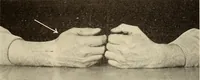 Picture 224 of 481 from Fractures and dislocations, diagnosis and treatment (1915), leaf 330