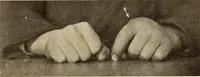 An illustration from Fractures and dislocations, diagnosis and treatment (1915)