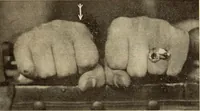 Picture 226 of 481 from Fractures and dislocations, diagnosis and treatment (1915), leaf 332