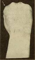 Picture 227 of 481 from Fractures and dislocations, diagnosis and treatment (1915), leaf 333