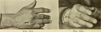 Picture 228 of 481 from Fractures and dislocations, diagnosis and treatment (1915), leaf 333