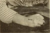 Picture 229 of 481 from Fractures and dislocations, diagnosis and treatment (1915), leaf 334