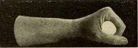 An illustration from Fractures and dislocations, diagnosis and treatment (1915)